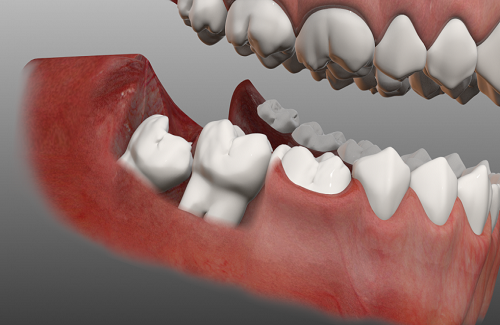 Răng khôn mọc lệch ngầm - Nguyên nhân, biến chứng và cách xử trí
