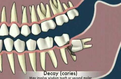 Răng khôn mọc kẹt - Phân loại, các nguy cơ của bệnh
