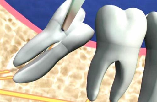 Các phương pháp điều trị răng khôn hàm dưới mọc lệch hiệu quả