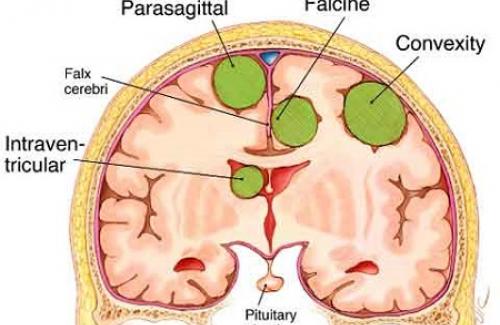 Thoát vị màng não tủy là gì? Triệu chứng và cách điều trị bệnh