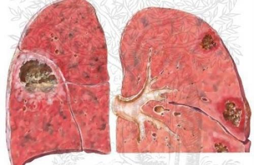 Xơ phổi là gì? Triệu chứng, nguyên nhân và điều trị bệnh