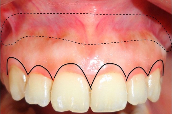 Viêm lợi sau khi bọc răng sứ - Nguyên nhân, biện pháp phòng ngừa, cách khắc phục