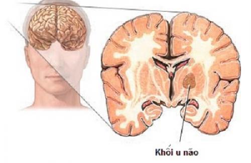 Phù não là bệnh gì? Triệu chứng và các nguyên nhân gây phù não