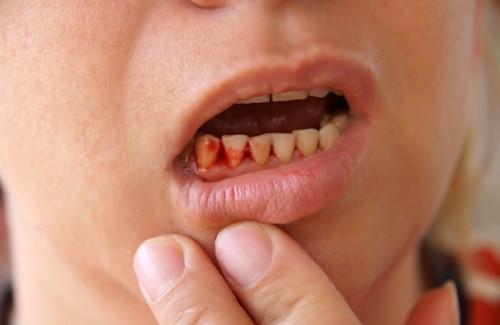 Chảy máu chân răng khi đánh răng - Nguyên nhân, hậu quả và cách khắc phục