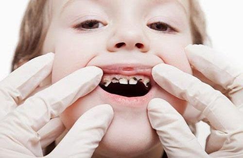 Trẻ bị sâu răng sữa có ảnh hưởng gì và có nguy hiểm không?