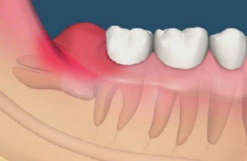 Cách điều trị răng khôn mọc lệch ở hàm dưới như thế nào?