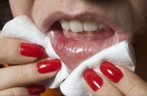 Mẹo chữa nhiệt miệng tại nhà bạn nên biết có khi cần dùng tới