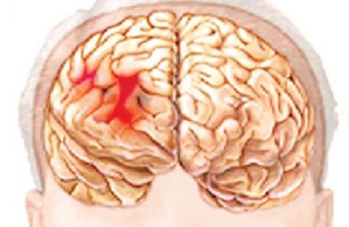 Thiểu năng tuần hoàn não là bệnh gì? Triệu chứng, nguyên nhân và điều trị bệnh