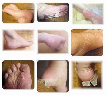 Da chân bị khô và bong tróc có sao không và xử lý thế nào?