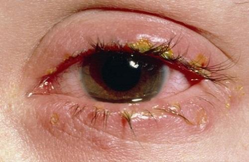 Một số bài thuốc trị đau mắt hột hiệu quả mà bạn cần chú ý