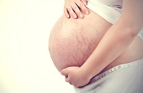 Tại sao bị rạn da khi mang thai khi mang thai bạn có biết không?