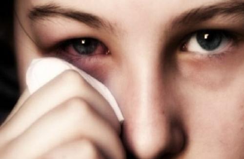 Viêm thượng củng mạc mắt là gì? Triệu chứng và biến chứng của bệnh