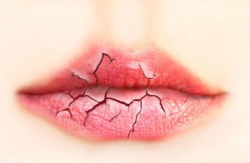 Những nguyên nhân gây bệnh nẻ môi là gì bạn biết không?