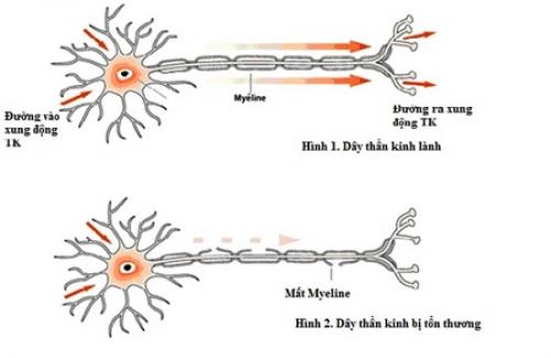 Viêm dây thần kinh ngoại biên là gì? Triệu chứng, nguyên nhân và điều trị bệnh