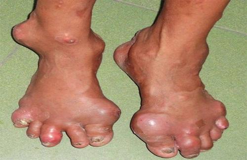 Bài thuốc dân gian chữa bệnh gout từ đu đủ và trà xanh