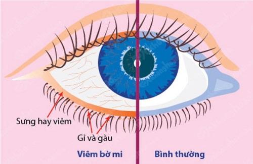 Biểu hiện của bệnh viêm bờ mi mắt và biến chứng thường gặp