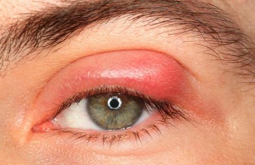 Dấu hiệu nhận biết viêm bờ mi  ở mắt là gì bạn biết không?