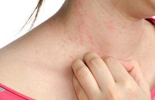Viêm da tiếp xúc dùng thuốc gì hiệu quả không để lại sẹo