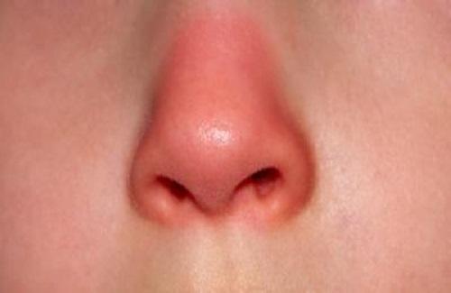 Chữa bệnh mũi đỏ thế nào dứt điểm nhanh khỏi bệnh