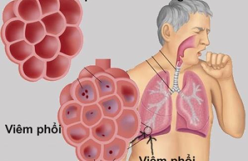 Viêm phổi do virus là gì? Triệu chứng, nguyên nhân và điều trị bệnh