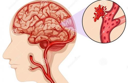 Dị dạng mạch máu não là gì? Triệu chứng, nguyên nhân và điều trị bệnh