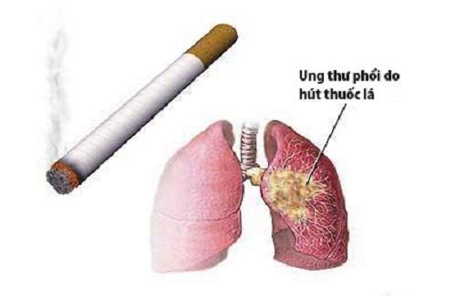 Những nguyên nhân dẫn đến ung thư phổi bạn cần lưu ý