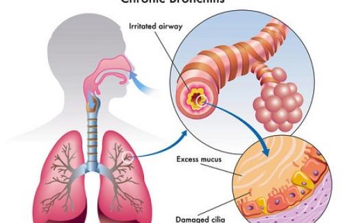 Viêm phế quản bội nhiễm là gì? Cách phòng tránh lao phổi bội nhiễm