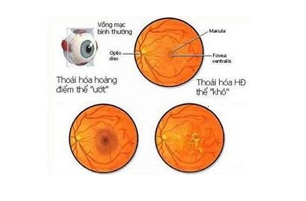 Cảnh báo: Thoái hóa hoàng điểm ở mắt có thể gây mù lòa