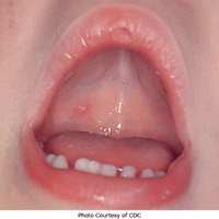 Loét miệng ở trẻ em, nguyên nhân và cách phòng bệnh