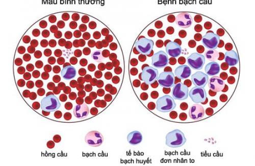 Nhiễm nấm máu là gì? Nguyên nhân và điều trị nấm máu hiệu quả