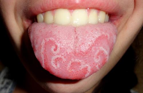 Viêm lưỡi bản đồ là gì? Triệu chứng, nguyên nhân và điều trị bệnh
