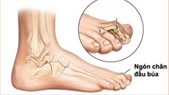 Tổn thương xương bàn chân ở bệnh nhân tiểu đường