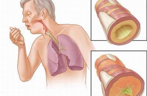 Tránh hút thuốc lá để giúp phòng ngừa viêm phế quản