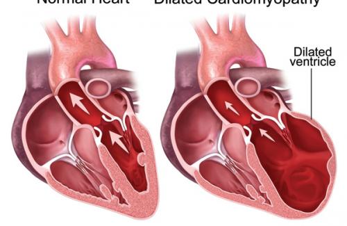 Suy tim cấp là gì? Nguyên nhân và phương pháp điều trị bệnh
