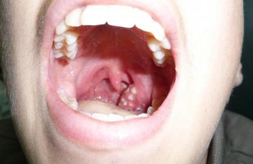 Hở vòm họng là gì? Triệu chứng, nguyên nhân và điều trị bệnh