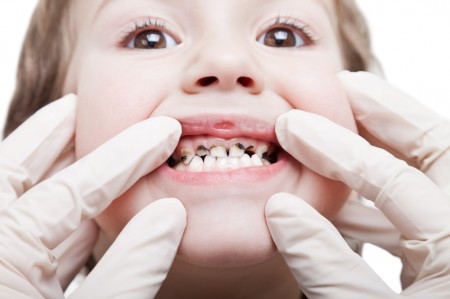 Vì sao răng bé bị đen - có phải do ăn quá nhiều kẹo?