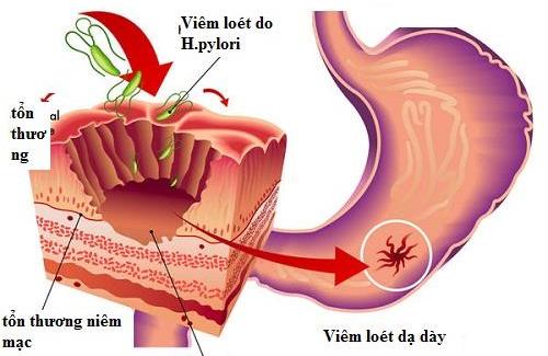 Bệnh viêm loét bờ cong nhỏ dạ dày - Nguyên nhân, triệu chứng