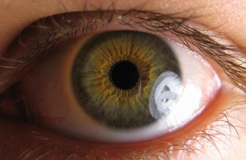 Mộng mắt là gì? Triệu chứng, nguyên nhân và điều trị bệnh