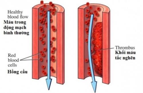 Viêm tắc động mạch là gì? Triệu chứng, nguyên nhân và điều trị bệnh