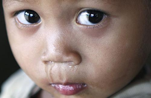 5 mẹo xử lý khi trẻ bị sổ mũi giúp bé sớm bình phục nhất