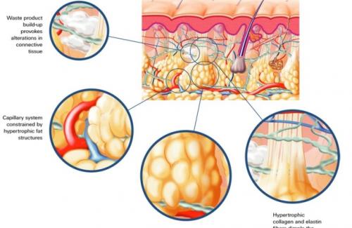 Mỡ trắng là gì? Mỡ trắng nguyên nhân gây thừa cân, béo phì