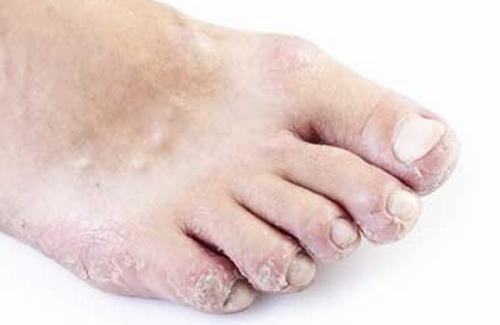 Nấm da chân là bệnh gì? Triệu chứng thường gặp ở bệnh nhân nấm da bàn chân