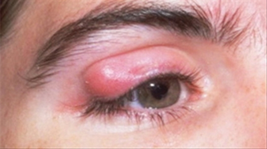 Biện pháp phòng tránh các bệnh thường gặp về mắt mùa hè