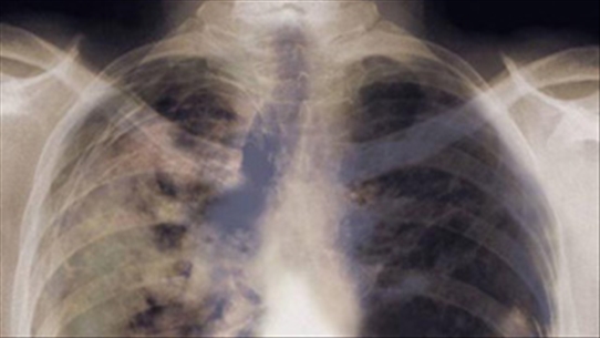 Điều trị ung thư phổi tại nhà để kiểm soát các triệu chứng