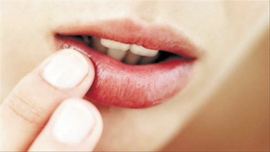 Điều trị bệnh viêm môi bong vảy như thế nào cho hiệu quả?