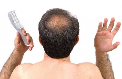 Bệnh hói đầu ở nam giới - Nguyên nhân và cách điều trị