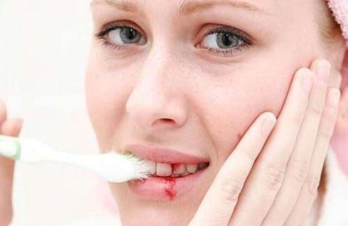 Viêm chân răng là gì? Triệu chứng, nguyên nhân và điều trị bệnh