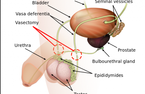 Thắt ống dẫn tinh và những điều cần biết về phẫu thuật thắt ống dẫn tinh