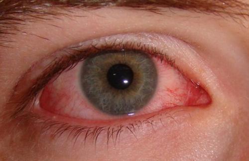 Bài thuốc trị đau mắt do dị ứng đơn giản hiệu quả ngay tại nhà