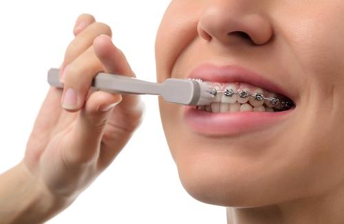 Những điều cần biết sau khi niềng răng và cách chăm sóc răng